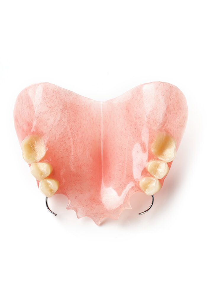 Upper Partial Dentures