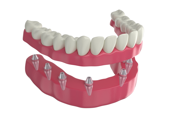 overdenture or implant supported denture