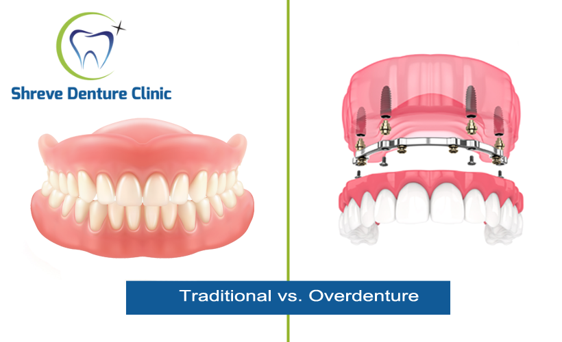 Traditional Dentures vs Implant supported Dentures